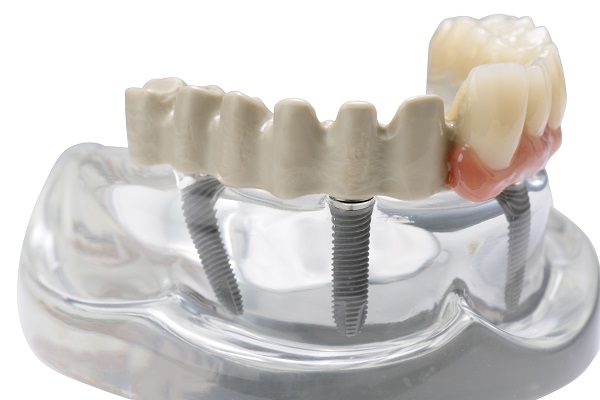 Dental full arch